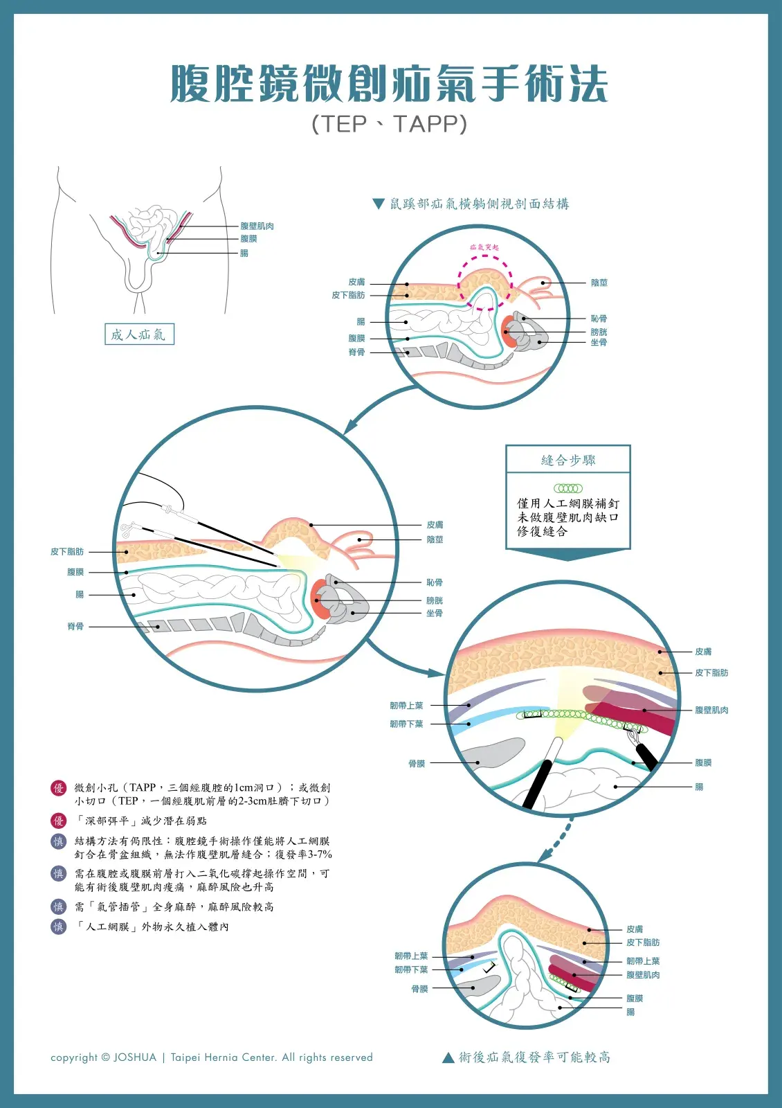腹腔鏡微創疝氣手術法（TEP、TAPP）海報：橫躺側視剖面圖顯示腹腔鏡器械進入位置，以及人工網膜覆蓋腹壁缺口並以釘合方式固定的示意