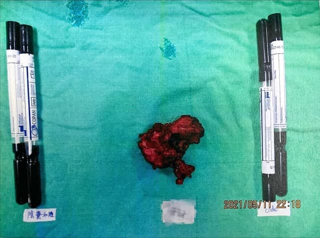 手術取出之人工網膜感染膿包檢體,置於手術巾上